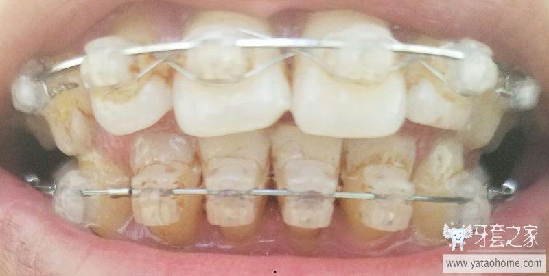 成人牙齿掉落如何修补视频,跟随视频学习修补技巧