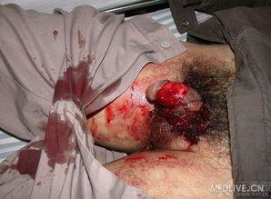 男性成人环切手术视频,男性成人环切手术全程解析与要点回顾