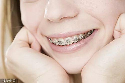 成人牙套固定方法图解视频,轻松掌握矫正步骤