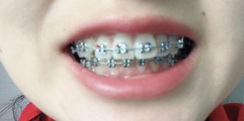 成人板牙怎么换新牙齿视频,视频教程详解